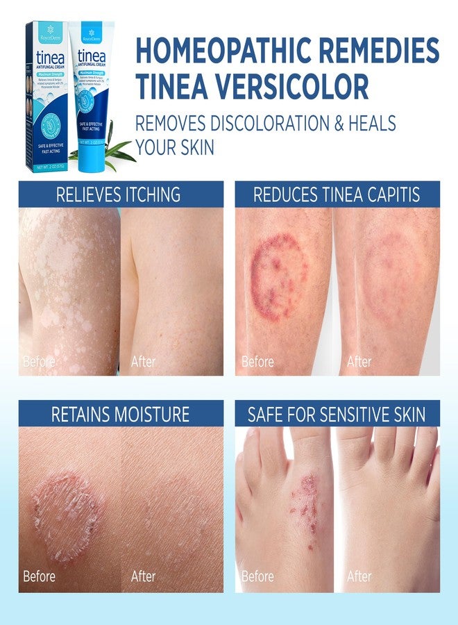 Roycederm Tinea Versicolor Treatment, Athletes Foot Treatment, Ringworm Treatment for Humans, for Tinea Versicolor & Pedis,Fast Healing Anti Fungal Skin Cream - Multi-Functional - Pack of 2 - Image 4